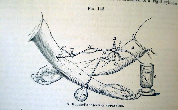 antique cupping apparatus